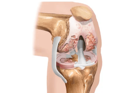 Arthrosis or arthritis of differences