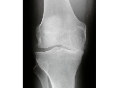 Diagnosis of the arthrosis of the knee joint