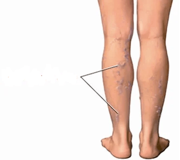 The consequences of knee osteoarthritis