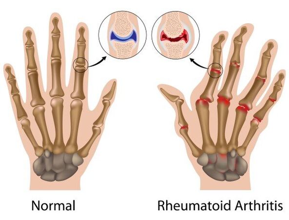 Finger joints without pathology and with rheumatoid arthritis