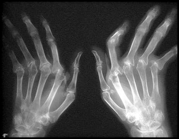 X -Ray image of the hands affected by osteoarthritis