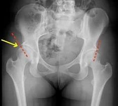 Methods for the treatment of osteoarthritis of the hip joint