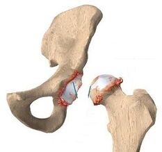 The reasons for the development of the arthrosis of the hip joint