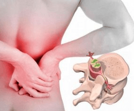 Lumbago at the beginning of the disease osteochondrosis