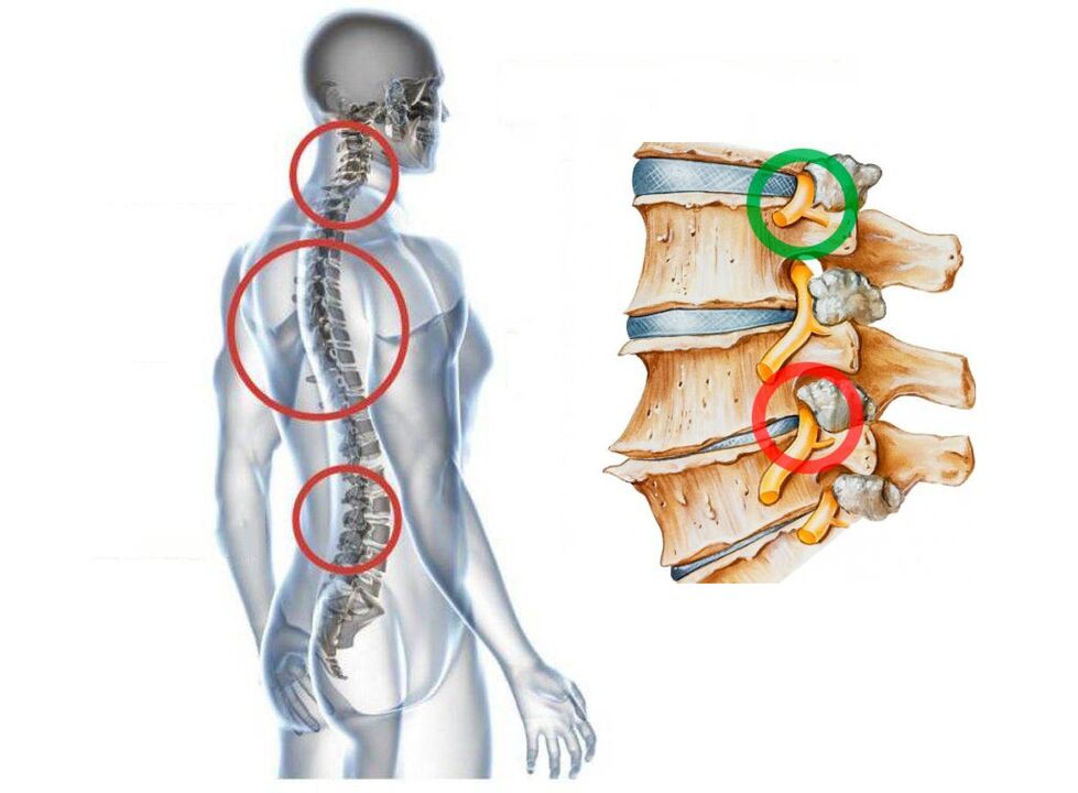 What does the cervical osteochondrosis look like the vertebrae