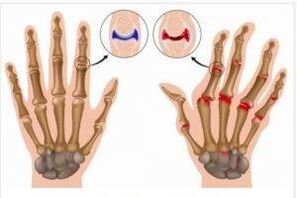 Differences between arthritis and arthrosis of the hands
