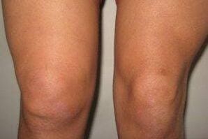 Inflammation in the knee joint with arthritis and arthrosis