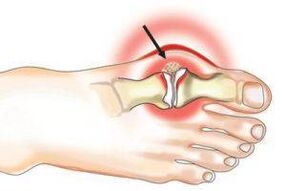 Joint damage caused by arthritis and arthrosis