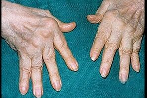 Symptoms of arthritis in the fingers