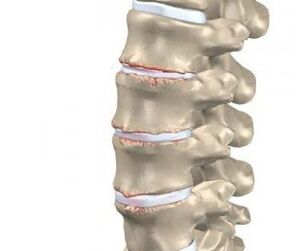 Development of spinal osteochondrosis