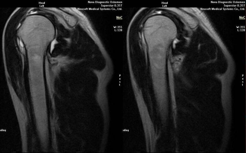 Osteoarthritis of the shoulder joint on x-ray