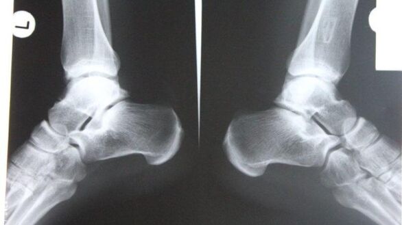Diagnosis of ankle osteoarthritis using x-rays