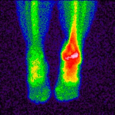 The method of differential diagnosis of cruciate osteoarthritis is scintigraphy
