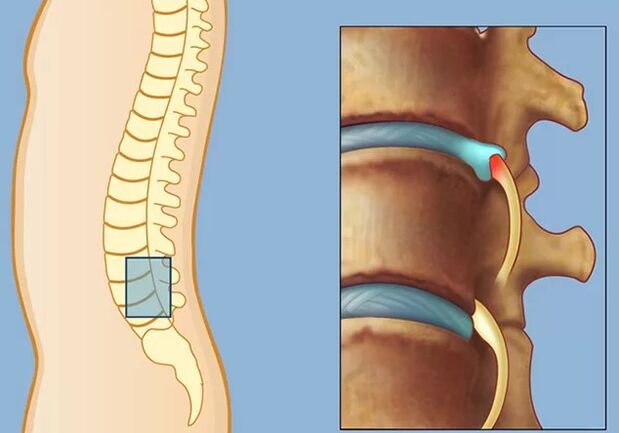 Rook syndrome